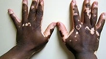 Vitiligo